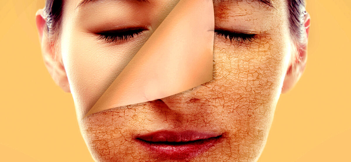 بوتاکس طبیعی