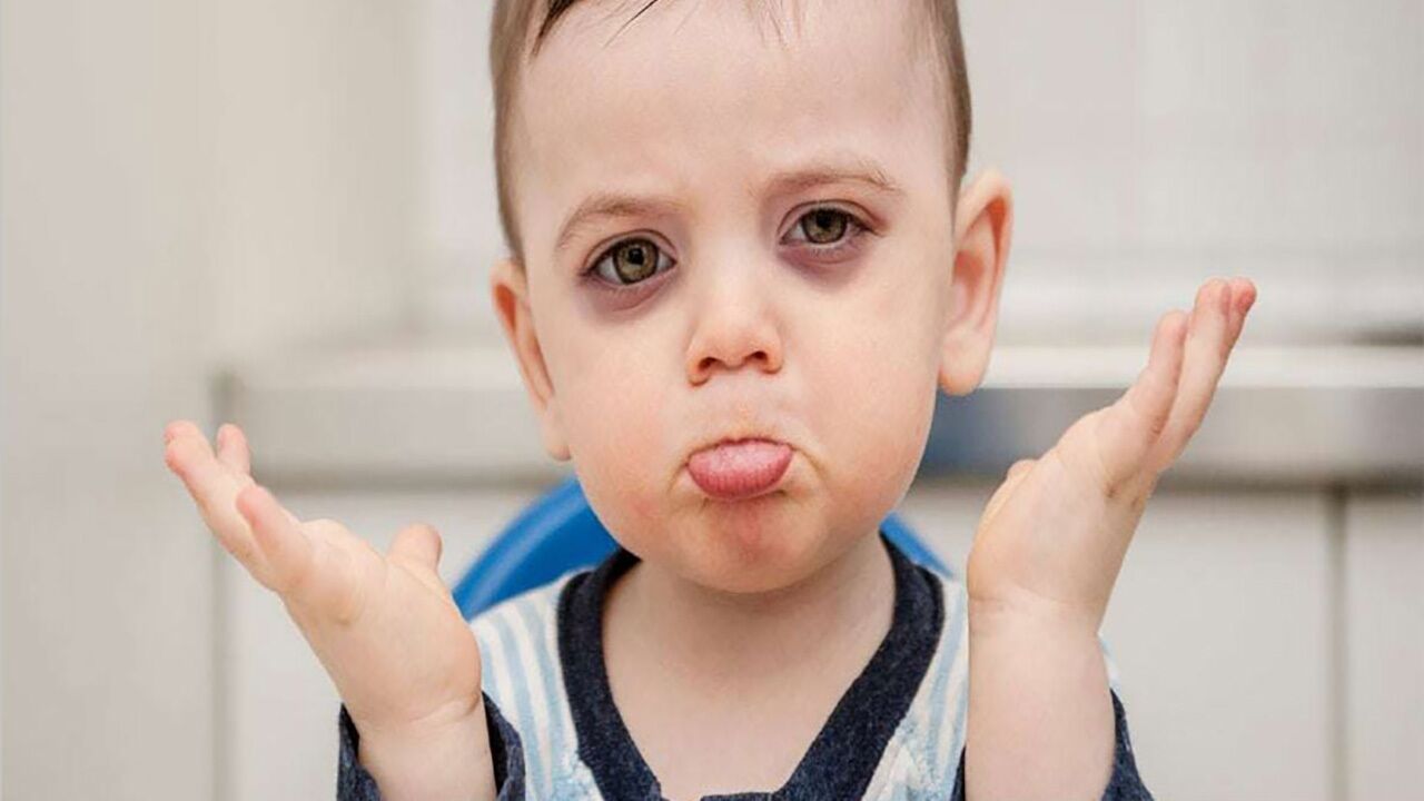 چرا زیر چشم کودکان سیاه می شود؟ | راهکارهای خانگی برای رفع سیاهی زیر چشم کودکان 