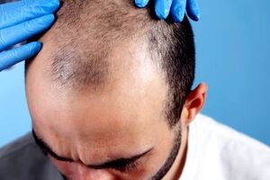مزاج بلغمی یا سرد و تر چیست و چه خصوصیاتی دارد؟ 