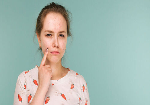 درمان همیشگی جوش صورت با رژیم حقیقت داره؟ | رژیم برای رفع جوش صورت
