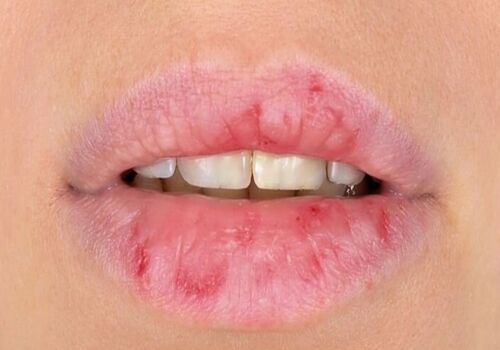 ویتامین ها چه ارتباطی با خشکی و پوسته شدن لب ها دارن؟ 